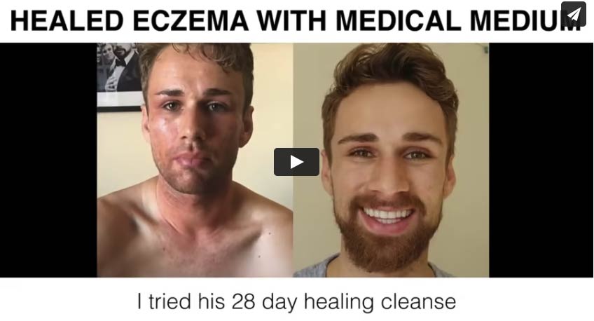 Healed from Eczema with Medical Medium