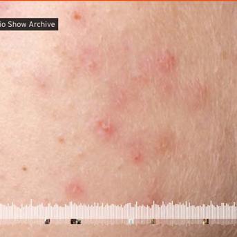 Healing Acne 
