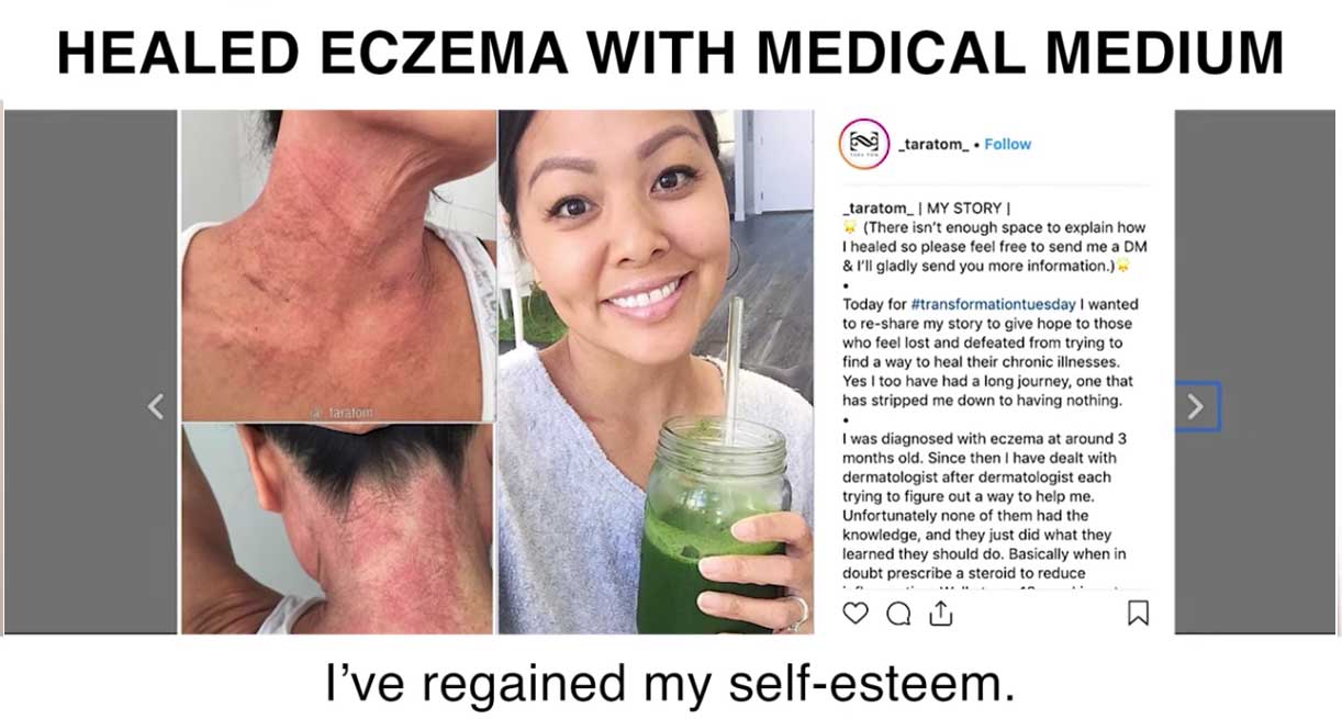 Healed Lifelong Eczema With Medical Medium