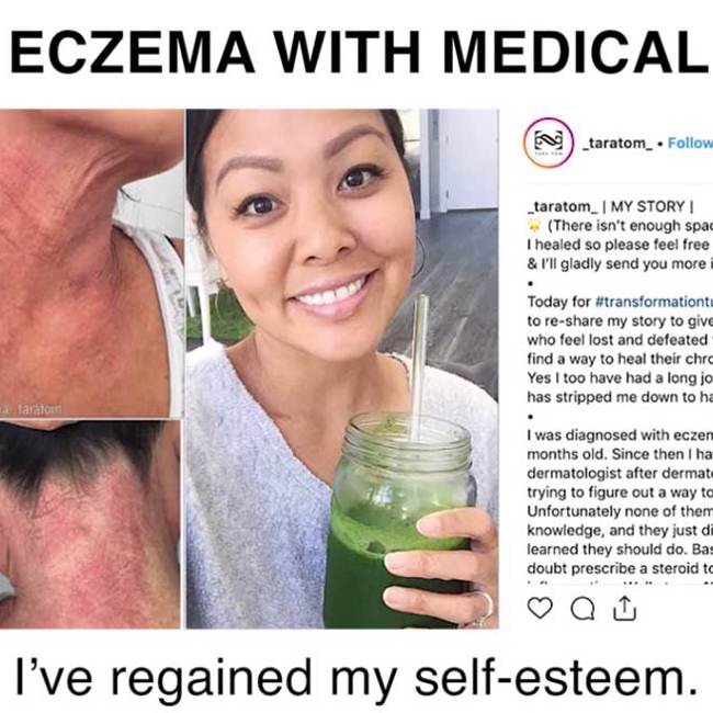 Healed Lifelong Eczema With Medical Medium