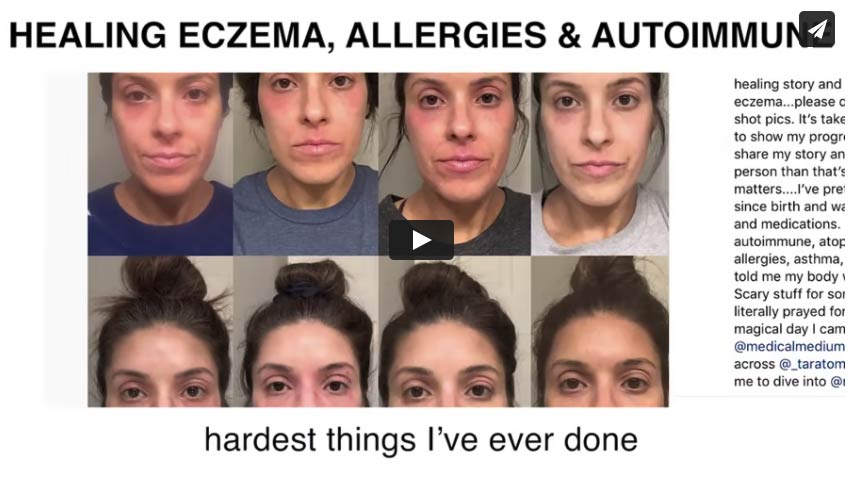Healing Eczema, Allergies, Asthma & Autoimmune Disease