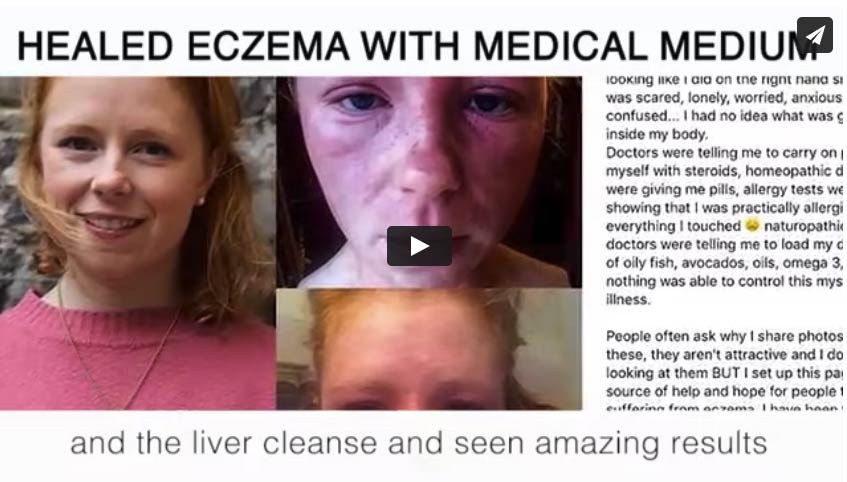 Healing Eczema with Medical Medium