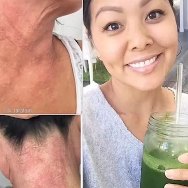 Healed Lifelong Eczema With Medical Medium