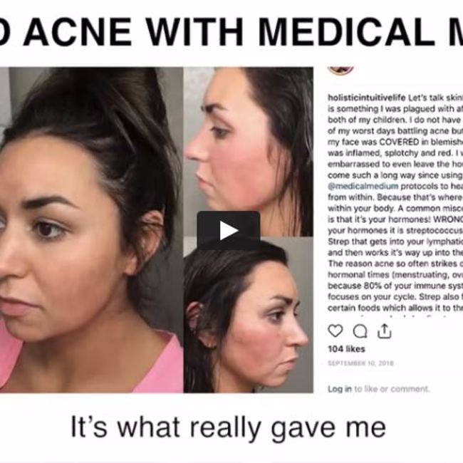 Healed Acne With Medical Medium